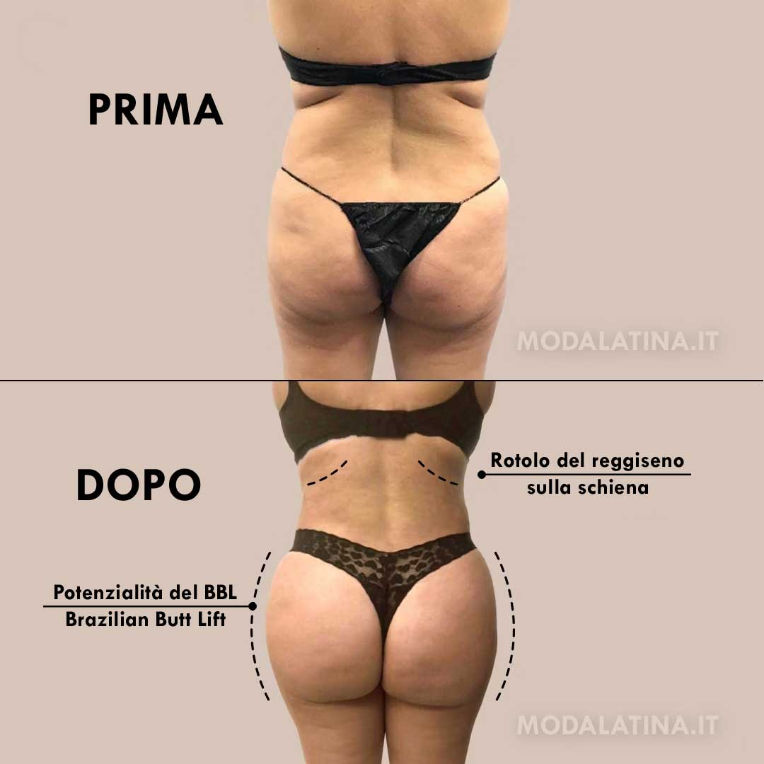 Guida Completa per Ottenere un Sedere Perfetto con il Brazilian Butt Lift (BBL)