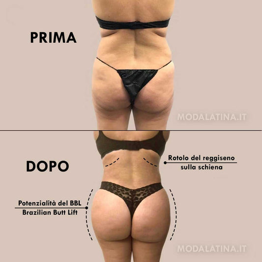 Guida Completa per Ottenere un Sedere Perfetto con il Brazilian Butt Lift (BBL)